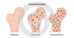 Osteoporosis medical poster