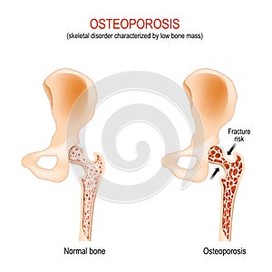 Osteoporosis. normal hip joint and bone with low bone mass