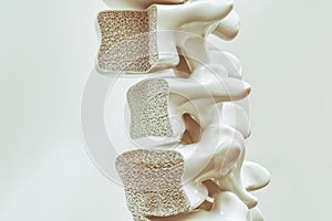 Osteoporosis on the spine - 3d rendering