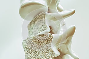 Osteoporosis on the spine - 3d rendering