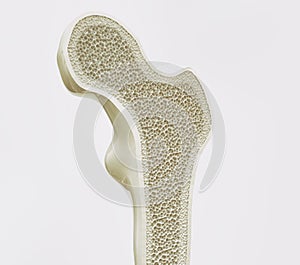 Osteoporosis stage 1 of 4 -- 3d rendering