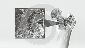 Osteoporosis stage 2 of 3 on white background -- 3d rendering