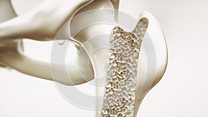 Osteoporóza fáze 4 z 4 horní končetina kost  trojrozměrný obraz vytvořený pomocí počítačového modelu 
