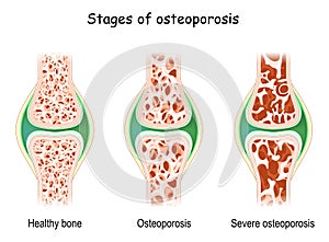 Osteoporosis stages. aging process with bone