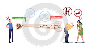 Osteoporosis, Symptoms, Health Care Concept. Tiny Male and Female Characters with Bones Disease near Huge Bone