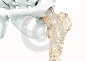 Osteoporosis - upper limb bones - 3d rendering