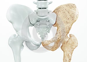 Osteoporosis - upper limb bones - 3d rendering