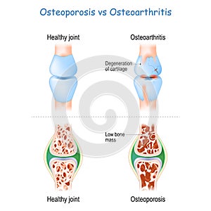 Osteoporosis vs Osteoarthritis