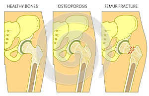 Osteoporosis1_with femur fracture and dislocation