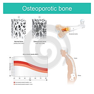 Osteoporotic bone. The old man`s health deteriorated because from the lack of calcium. photo