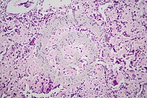 Osteosarcoma, a malignant bone tumor, light micrograph under the microscope