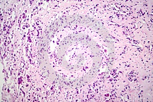 Osteosarcoma, a malignant bone tumor, light micrograph under the microscope