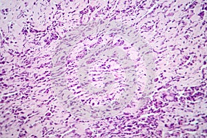 Osteosarcoma, a malignant bone tumor, light micrograph under the microscope