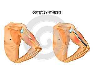 Osteosynthesis of the body of the humerus