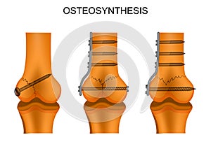 Osteosynthesis of the femur photo
