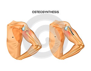 Osteosynthesis in the fracture of the humerus head
