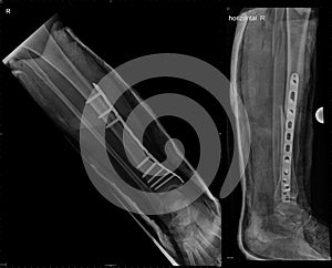 Osteosynthesis of fractured tibial bone