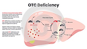 Ornithine Transcarbamylase (OTC) Deficiency diagram vector photo