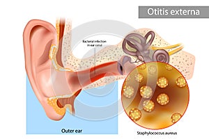 Otitis externa also called swimmer's ear. Inflammation ear canal of the Staphylococcus aureus.. Human Ear Anatomy photo