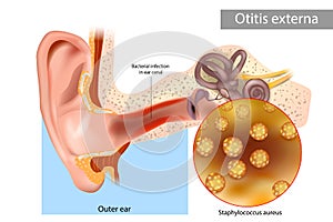 Otitis externa also called swimmer's ear. Inflammation ear canal of the Staphylococcus aureus.. Human Ear Anatomy photo