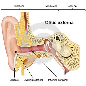 Otitis externa ear disease 3d medical vector illustration on white background