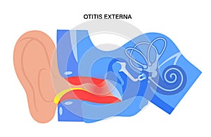 Swimmers ear otitis photo