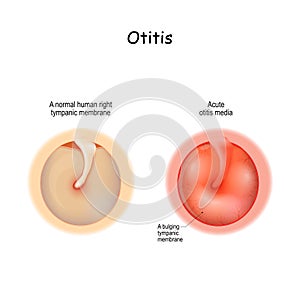 Otitis. Healthy membrane, and bulging tympanic membrane of Acute otitis media photo