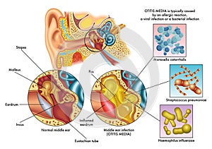 Otitis media