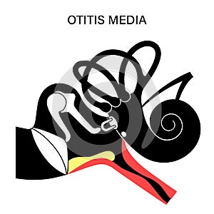 otitis media disease