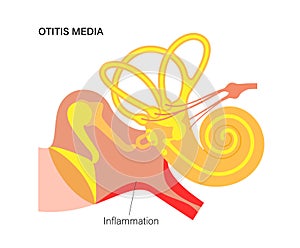 otitis media disease