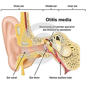 Otitis media ear disease 3d medical vector illustration on white background photo