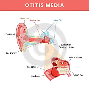 Otitis Media Of Ear Disease Infographic Structure Colorful
