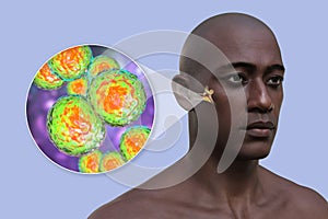 Otitis media ear infection, 3D illustration