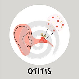 Otitis media flat vector medically illustration. Earache becouse of infection in the middle ear. Inflammatory diseases