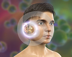 Otitis media, a group of inflammatory diseases of the middle ear photo