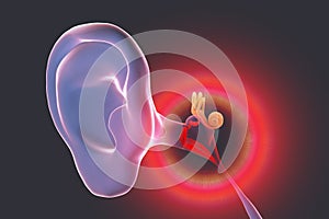 Otitis media, illustration