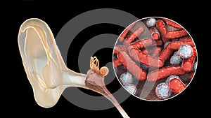 Otitis media, inflammatory disease of the middle ear