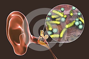 Otitis media, inflammatory disease of the middle ear