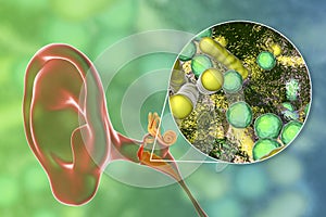 Otitis media, inflammatory disease of the middle ear