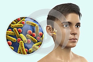 Otitis media, inflammatory disease of the middle ear photo