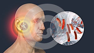 Otitis media, inflammatory disease of the middle ear, 3D illustration photo