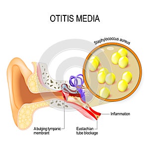 Otitis media and Staphylococcus aureus photo