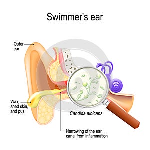 Otitis. swimmer`s ear is inflammation of the ear canal and fungal infection that caused this disease. Candida albicans photo