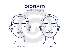 Otoplasty. Ear surgery before and after. Vector illustration of female face. Plastic surgery icons photo