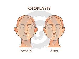 Otoplasty. Ear surgery. Vector illustration of female face before and after. Plastic surgery photo