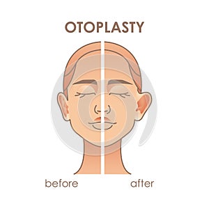 Otoplasty. Ear surgery before and after. Vector illustration of female face. Plastic surgery photo