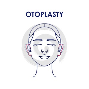 Otoplasty. Ear surgery. Vector illustration of female face. Plastic surgery photo
