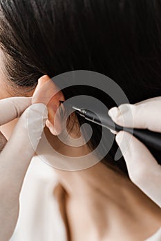 Otoplasty markup close-up before ear surgery. Surgeon draw marking on ear before otoplasty cosmetic surgery. Otoplasty
