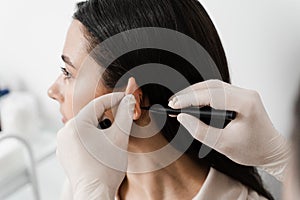 Otoplasty markup for surgical reshaping of the pinna, or outer ear for correcting an irregularity and improving