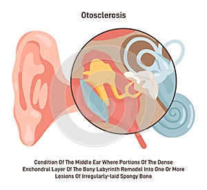 Otosclerosis. Medical condition of the middle ear bones inside